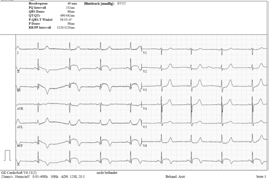 Subakuter STEMI der Hinterwand (inferior)