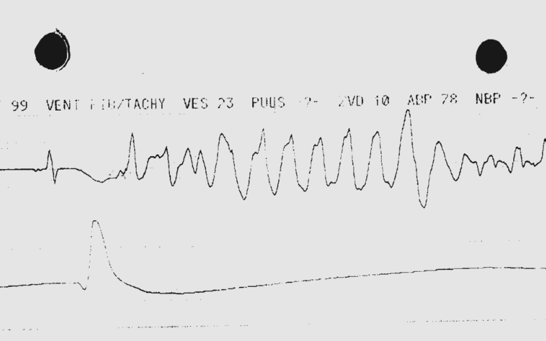 Torsades-de-pointes-Tachykardie